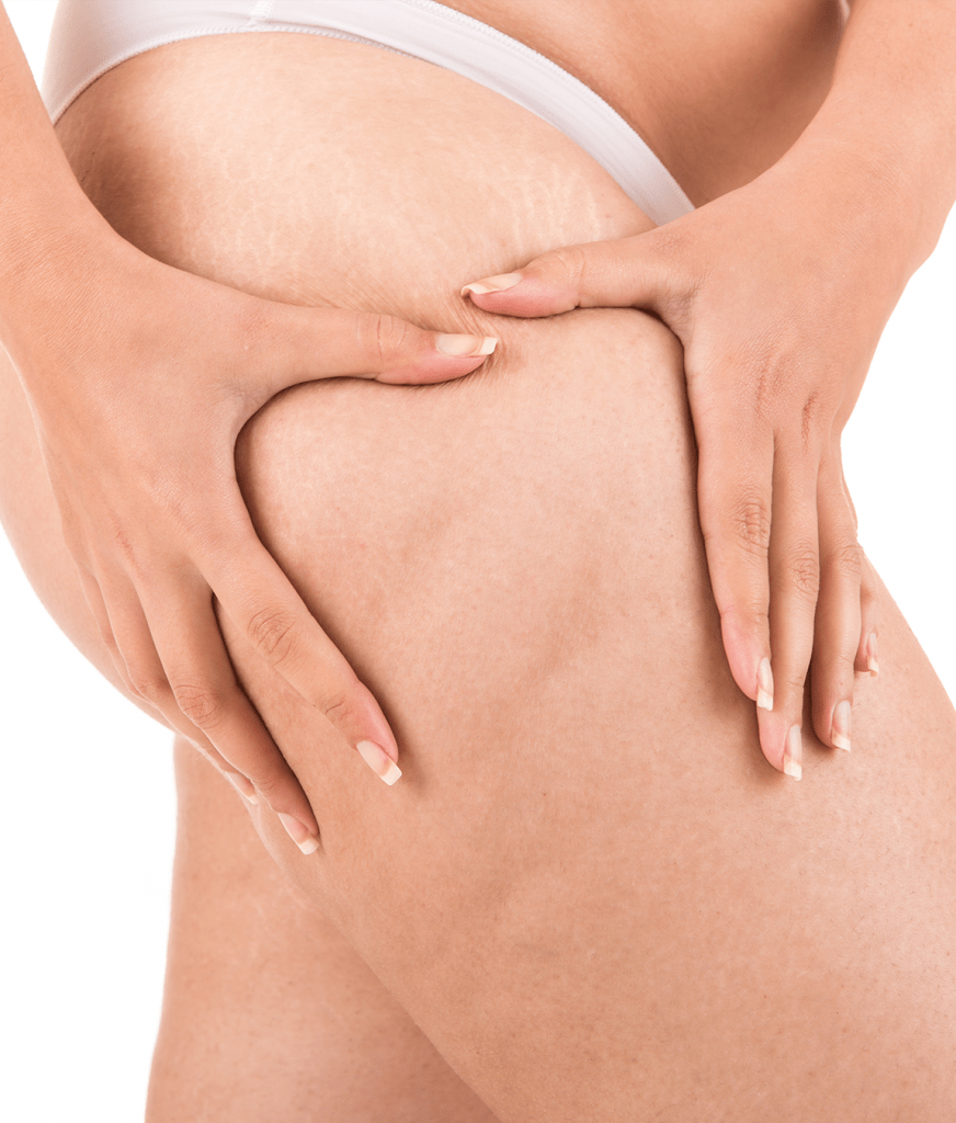 Cellulite on a woman's thigh