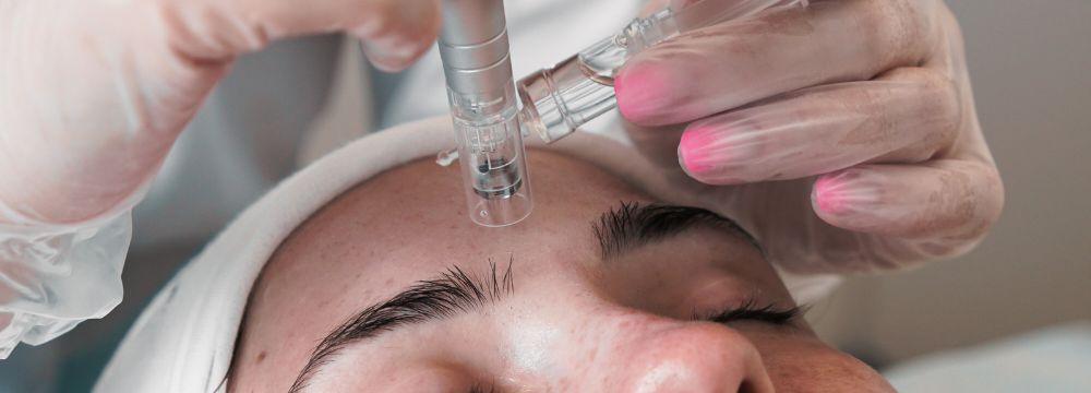 woman getting microneedling treatment on forehead